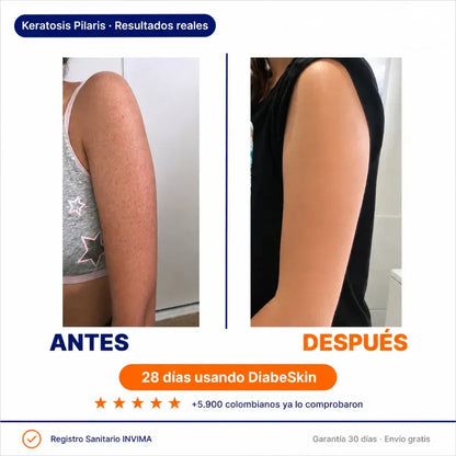 Diabeskin™ | Adios a la piel aspera, reseca y con picazon