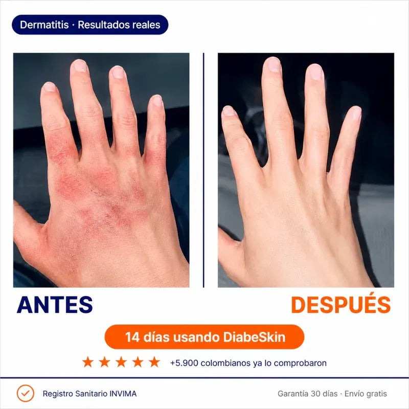 Diabeskin™ | Adios a la piel aspera, reseca y con picazon
