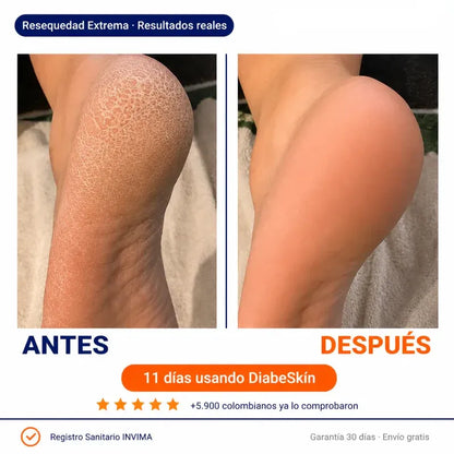 Diabeskin™ | Adios a la piel aspera, reseca y con picazon