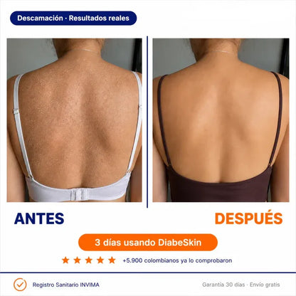 Diabeskin™ | Adios a la piel aspera, reseca y con picazon
